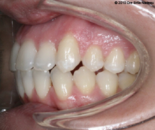 Marie-Hélène Cyr - Left lateral intraoral view - After orthodontic treatments and orthognathic surgeries (January 29, 2010)
